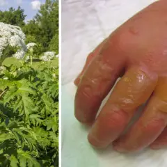 Riesige Herkulesstaude neben einer Hand mit schweren Brandblasen, die durch Kontakt mit der Pflanze entstanden sind.