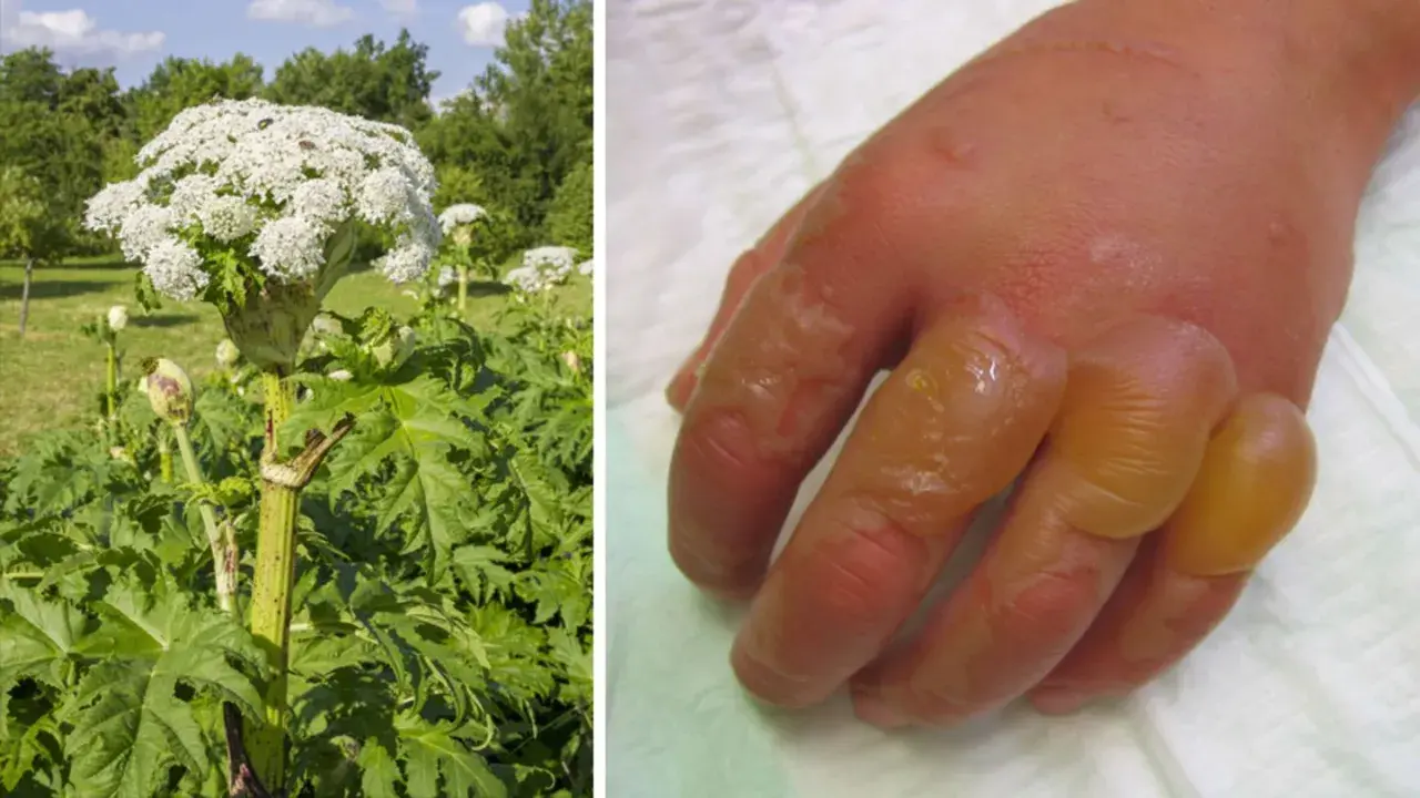 Riesige Herkulesstaude neben einer Hand mit schweren Brandblasen, die durch Kontakt mit der Pflanze entstanden sind.